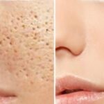 HOW TO REDUCE LARGE PORES: A GUIDE TO KNOWING THIS